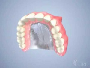 Prothèse dentaire partielle (partiel)